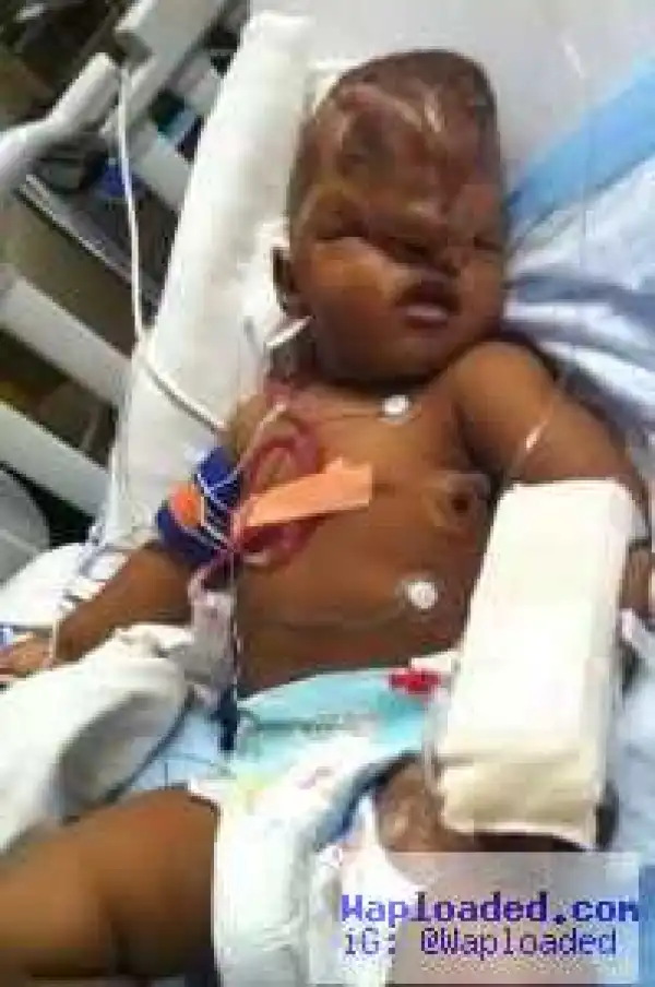 Photos: 22-Month-Old Girl Undergoes Successful Skull Defect Surgery In Canada